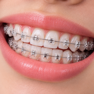 Behel Self-Ligating Clear